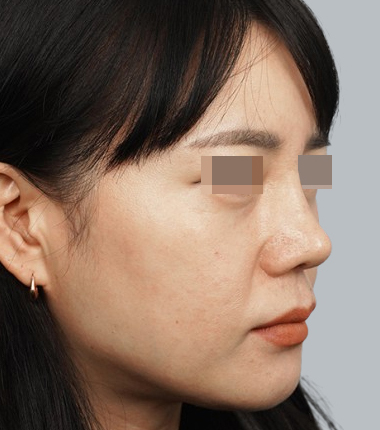 3D맞춤보형물+자가늑연골 한달 후