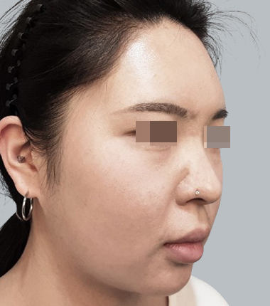 수술전
