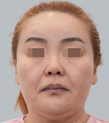 수술전
