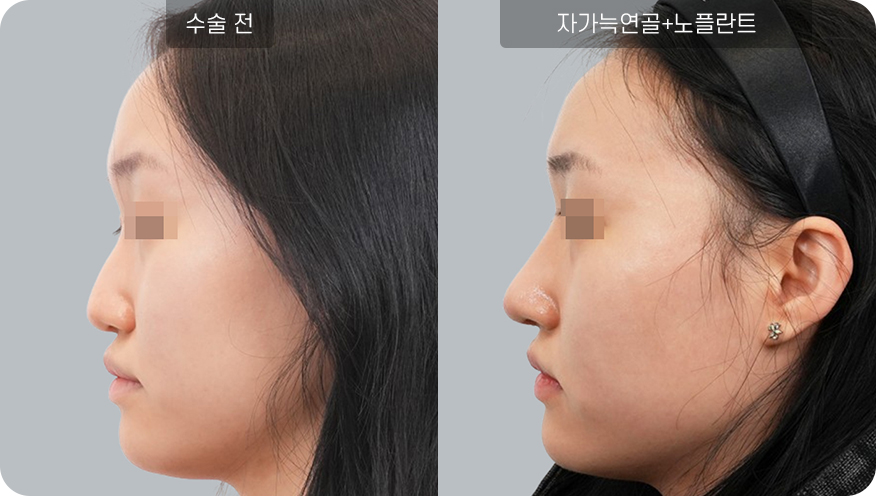 코성형수술전후사진
