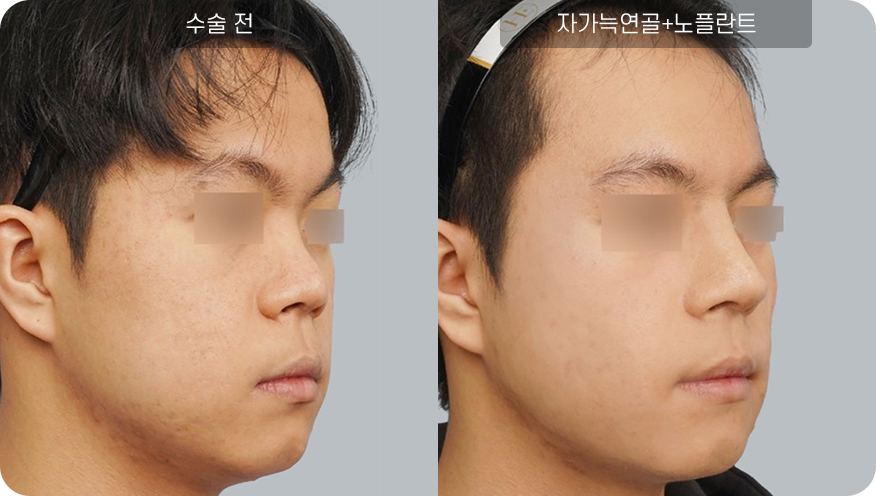 코성형수술전후사진