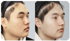코성형수술전후사진