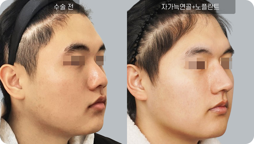 코성형수술전후사진