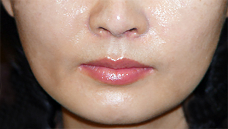 광대, 사각턱축소 한달 후