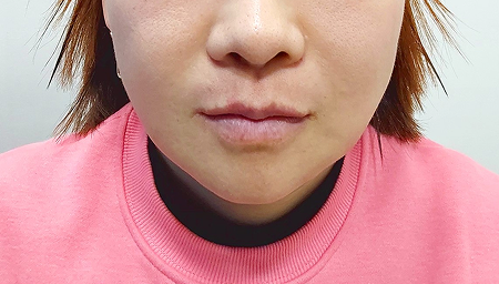 광대, 사각턱축소 6개월 후