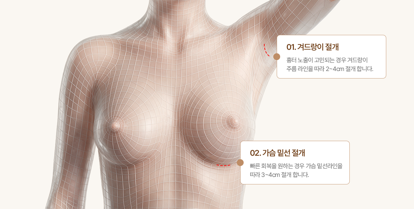 가슴성형 절개 부위별 특징