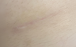 울트라펄스 앙코르 흉터치료 3회차