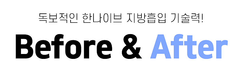 한나이브지방흡입beforeafter