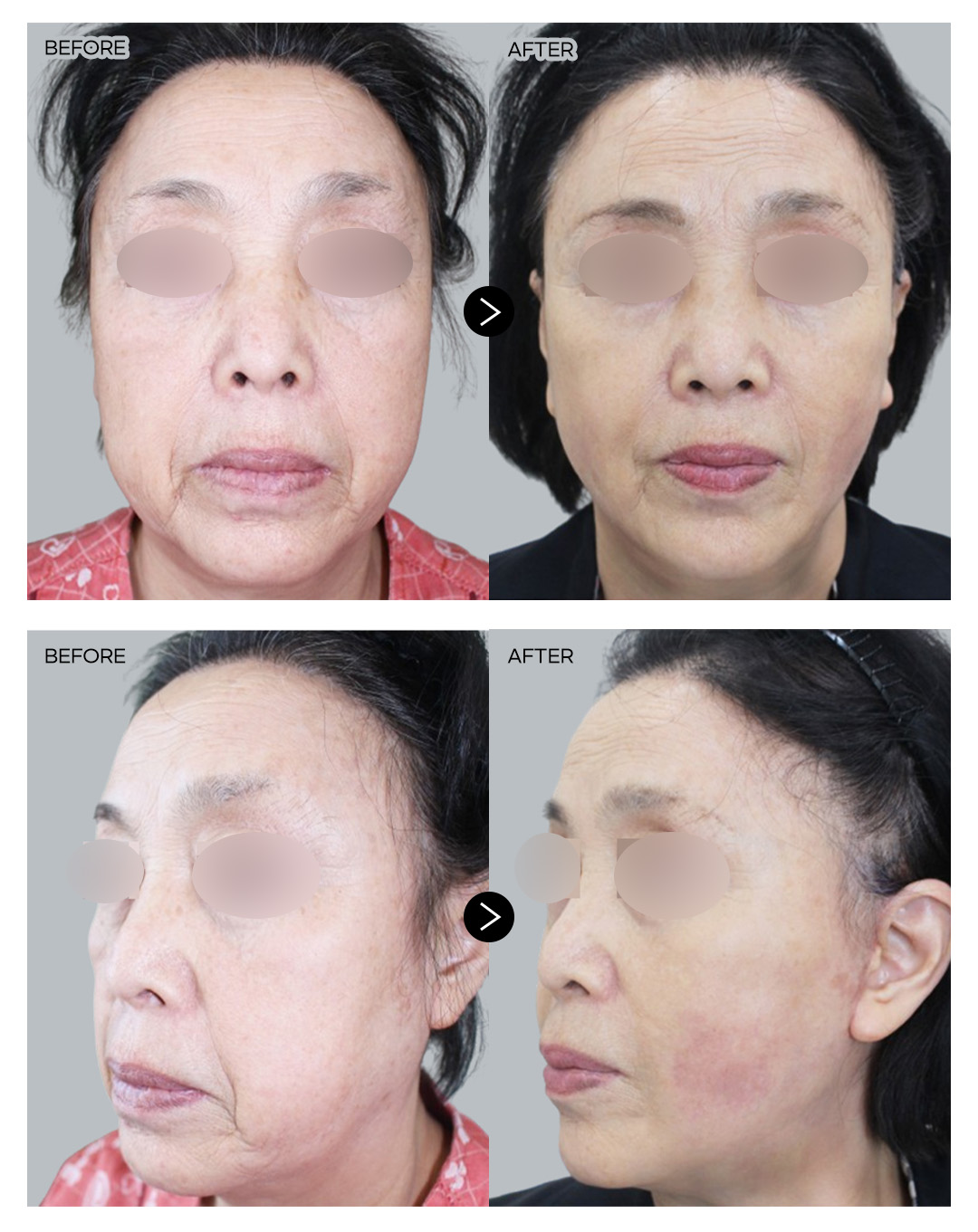 안면거상술 전후 1