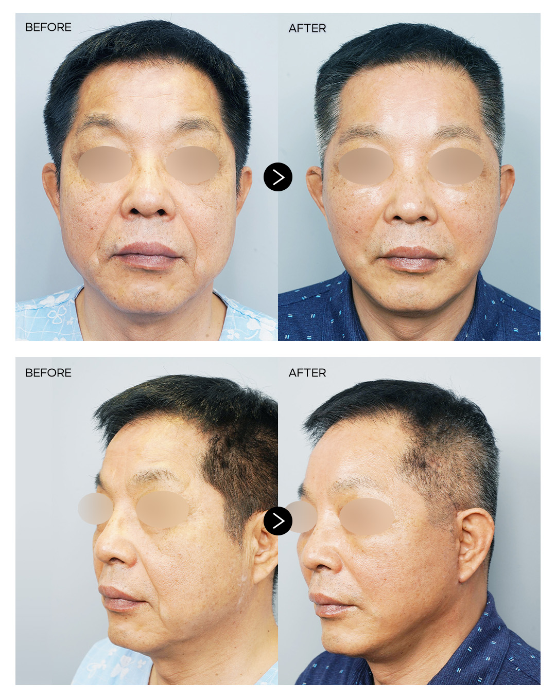 안면거상술+이마거상술+상하안검 전후