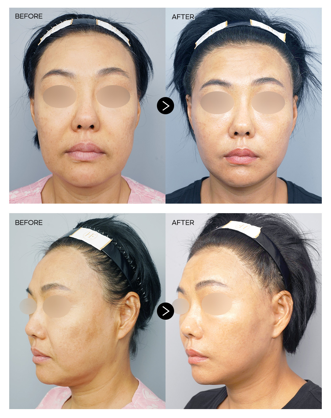 안면거상술 전후 2