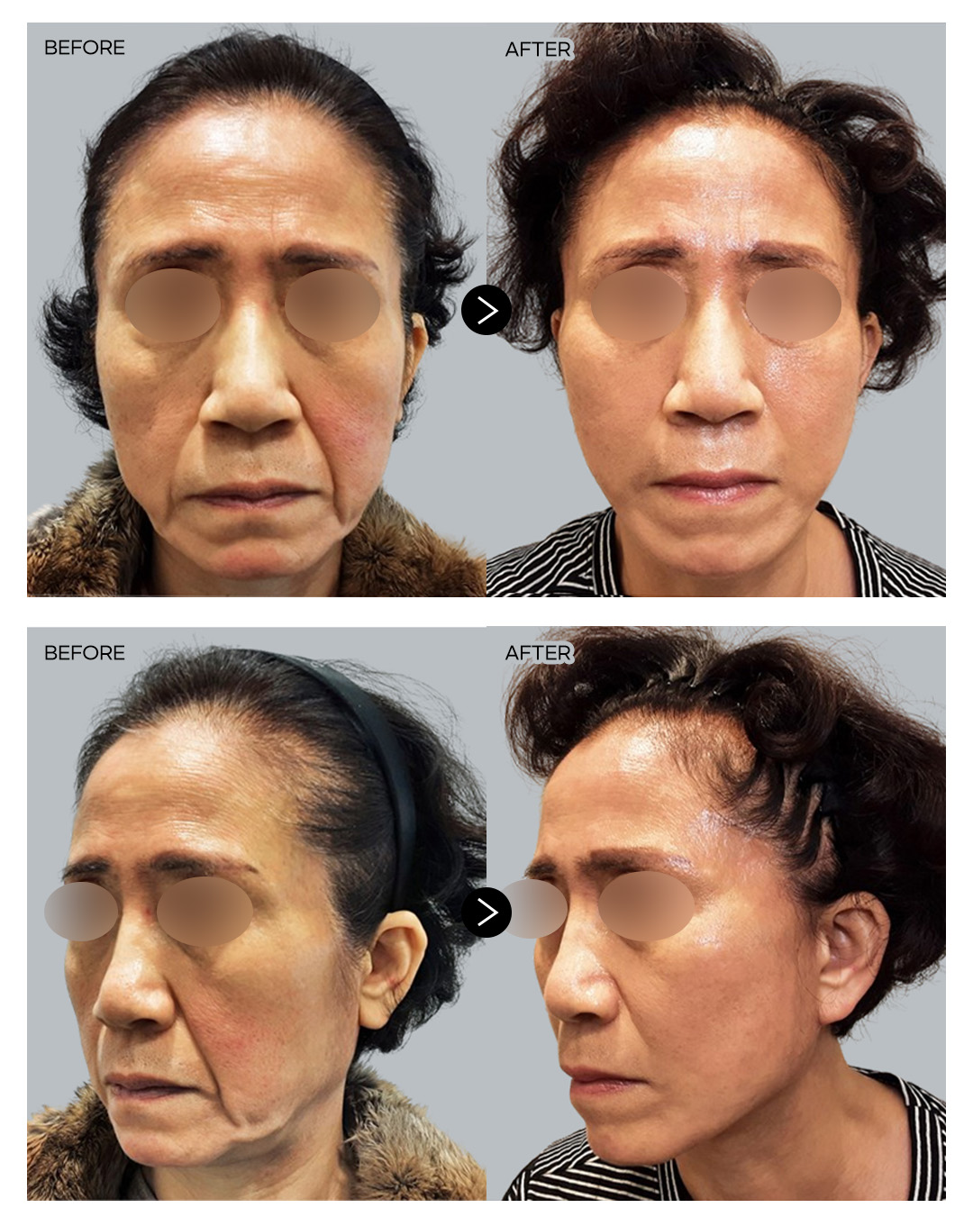 안면거상술 전후 3