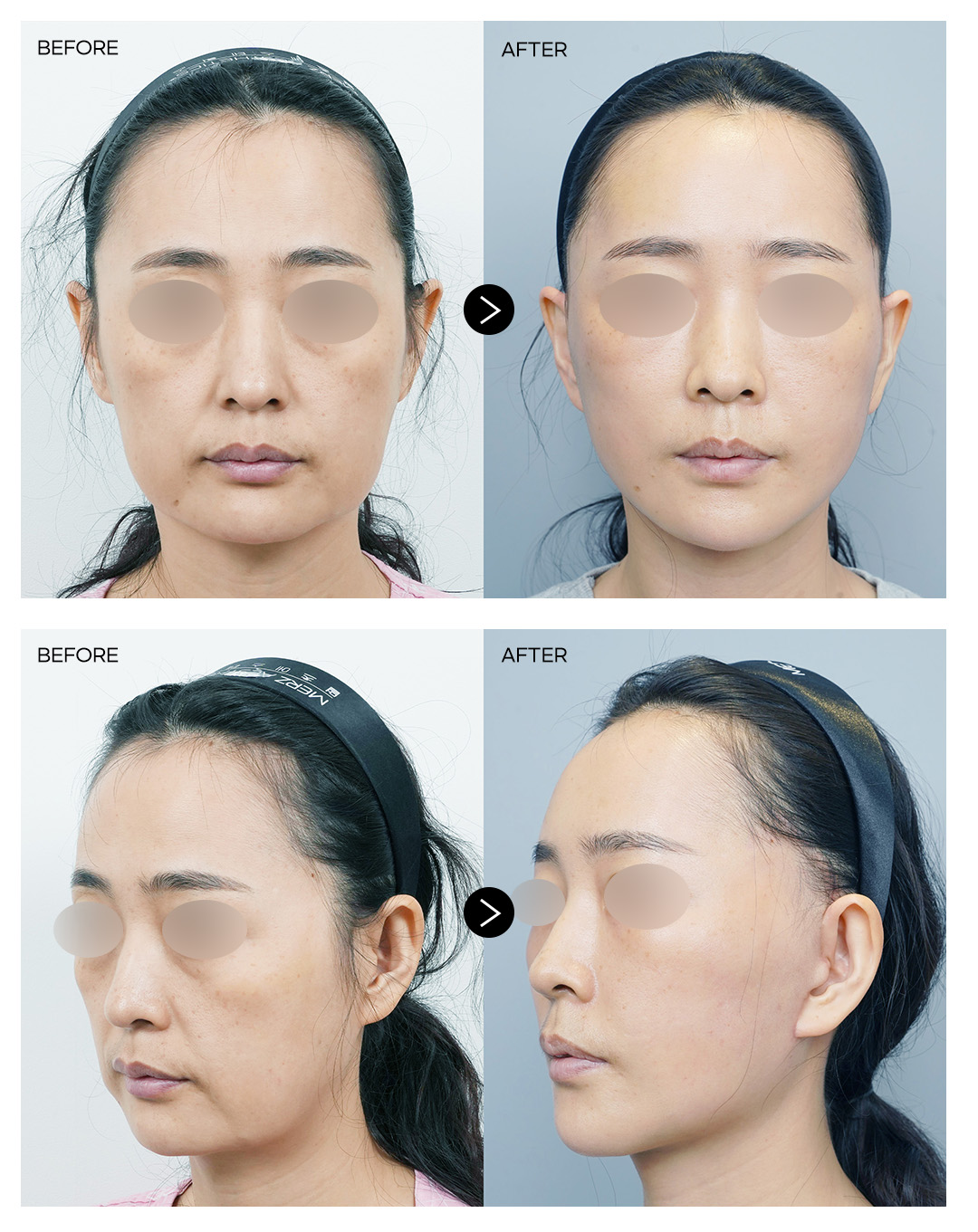 안면거상+하안검re+이마앞광대팔자 전후