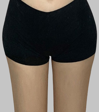 골반 필러 시술 후