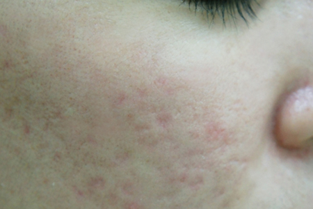 색소+여드름 3주 후