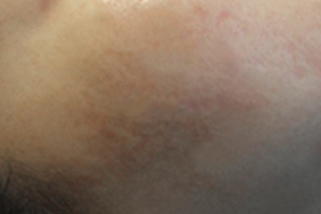 색소+여드름 3주 후