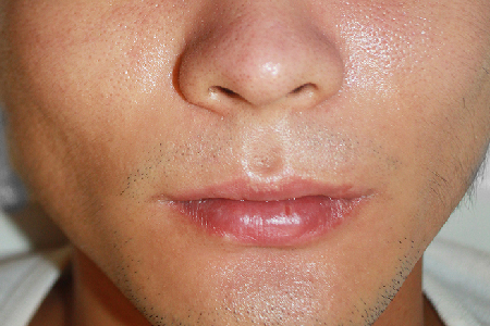 프락셀(모공축소) 치료 후