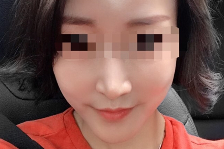 샤넬주사 2주 후