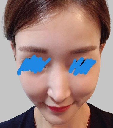 볼필러 2주 후