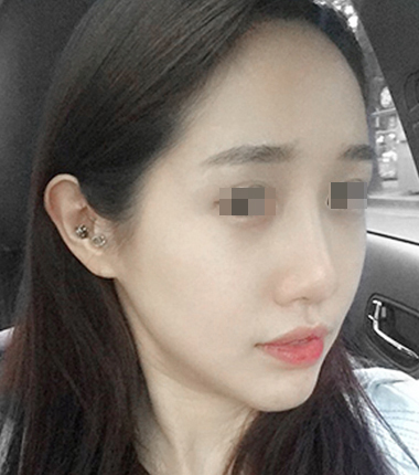시술전