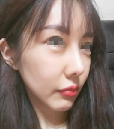 시술전