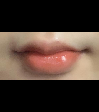 입술필러 시술 후