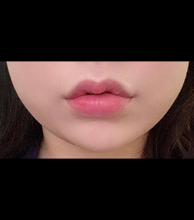 시술전