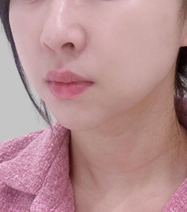 시술전