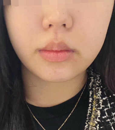 시술전