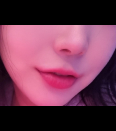 버츄RF 시술 후