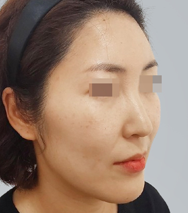 수술전