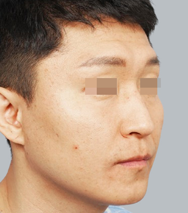 수술전