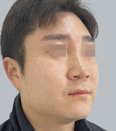 수술전