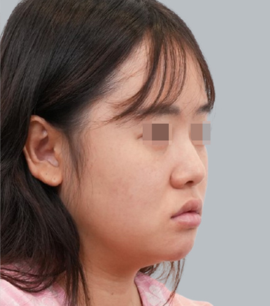 수술전
