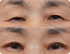 상안검수술전후사진