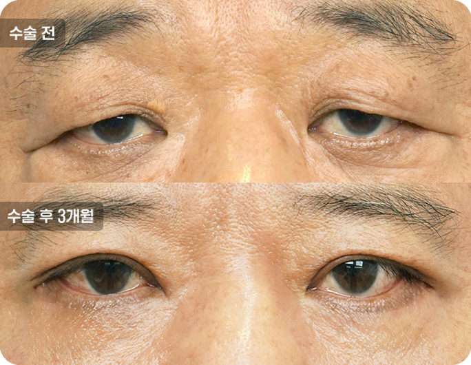 상안검수술전후사진