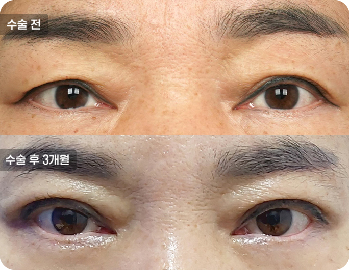 상안검수술전후사진