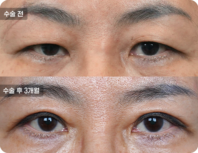 상안검수술전후사진