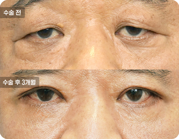 하안검수술전후사진