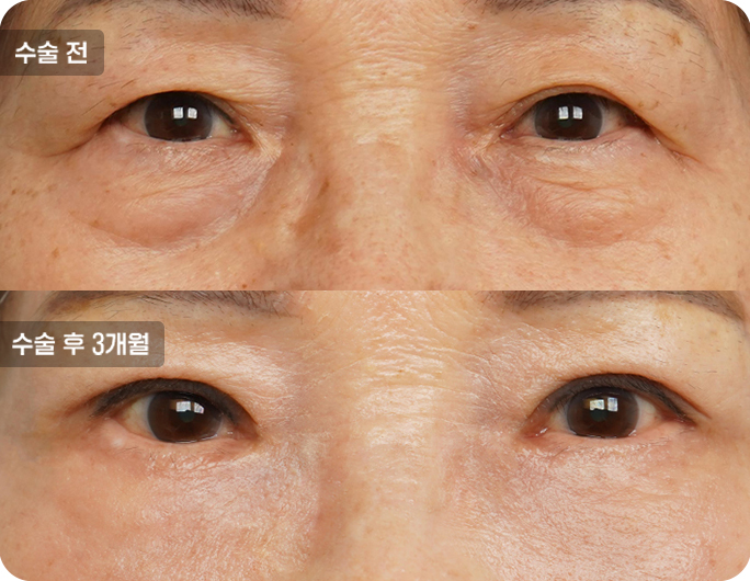 하안검수술전후사진