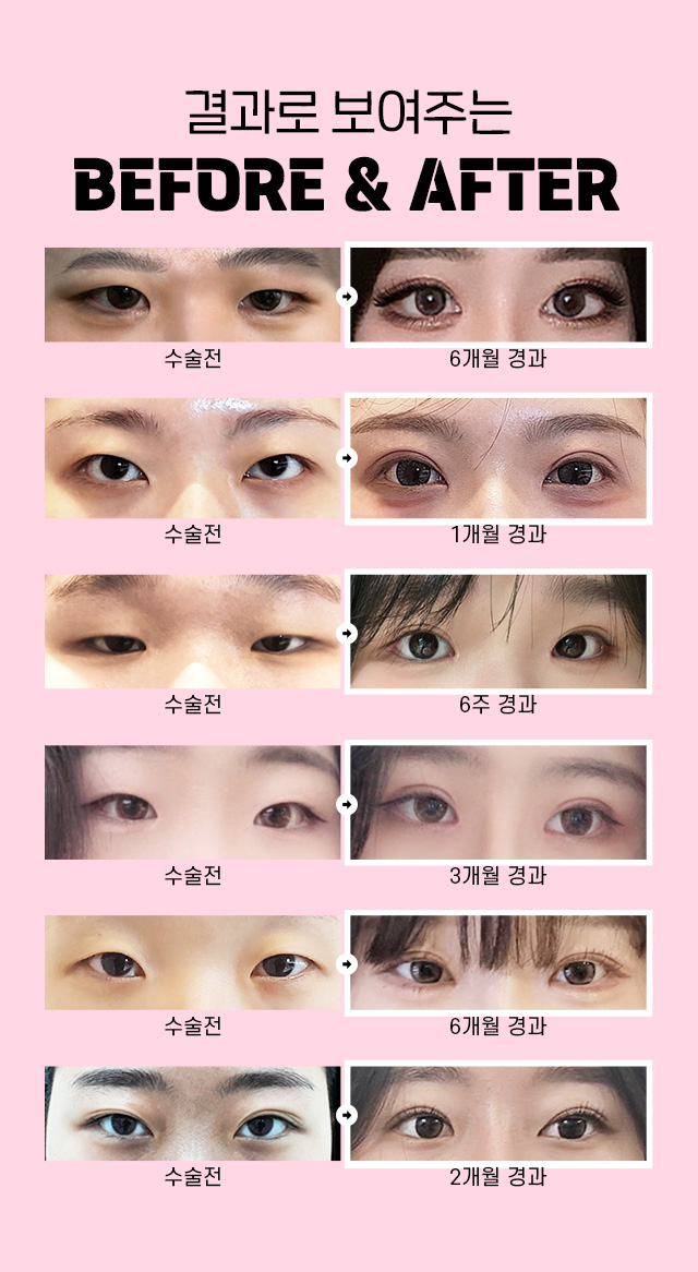 눈성형전후사진