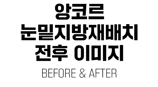 눈밑지방재배치전후이미지