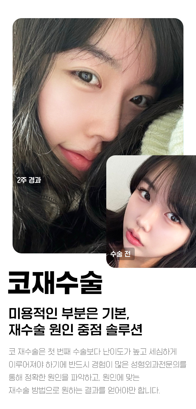 한나이브코재수술