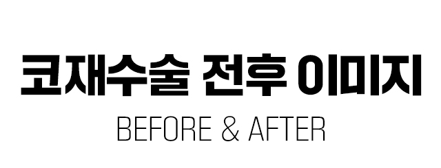 코성형전후이미지