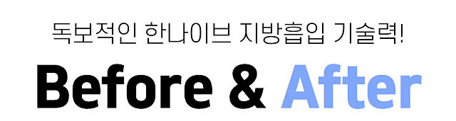 복부지방흡입beforeafter