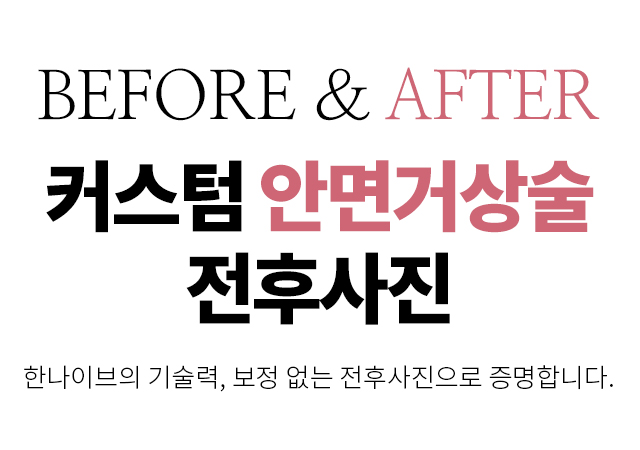 커스텀안면거상전후사진
